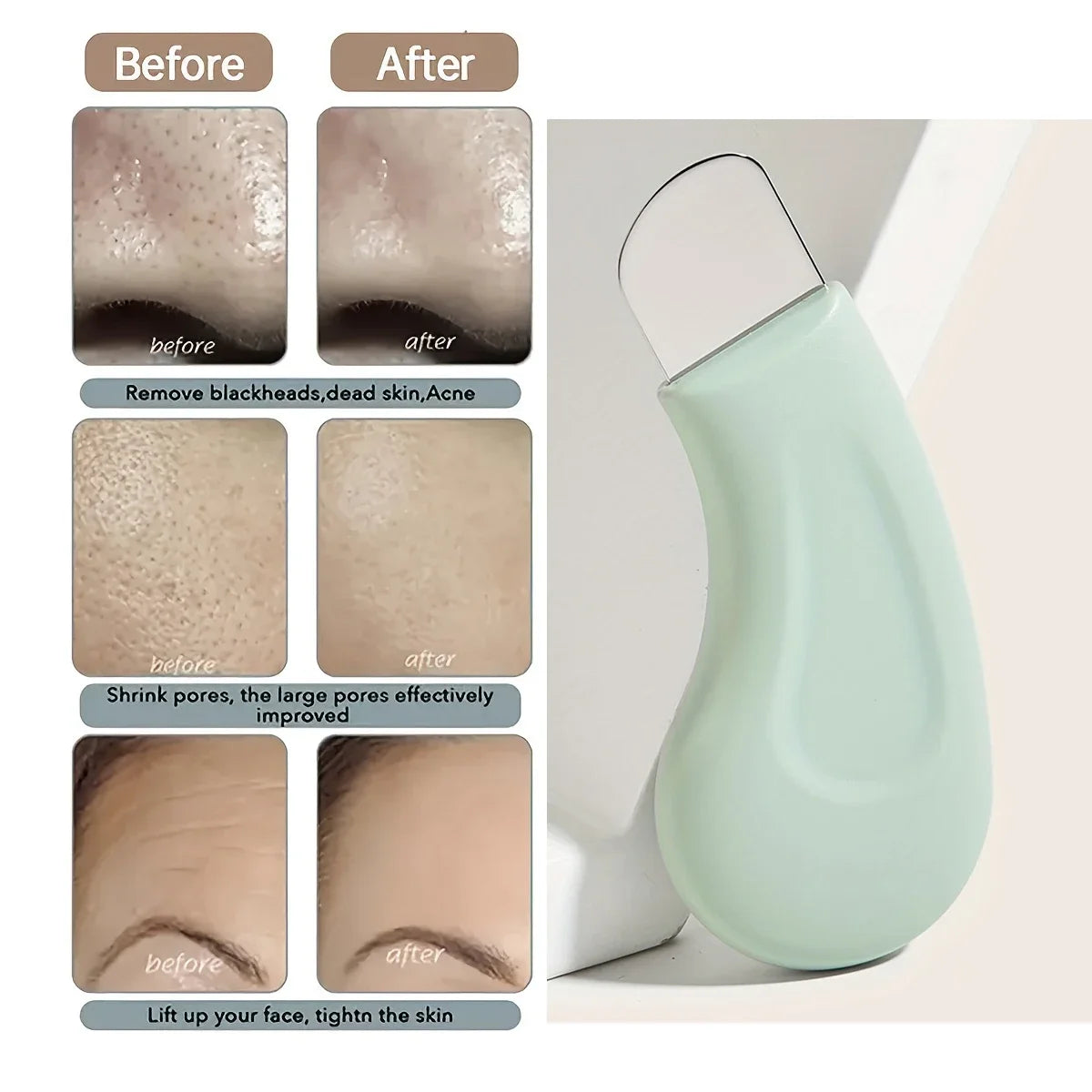 Blackhead and Whitehead Removal Tool for Nose and Face